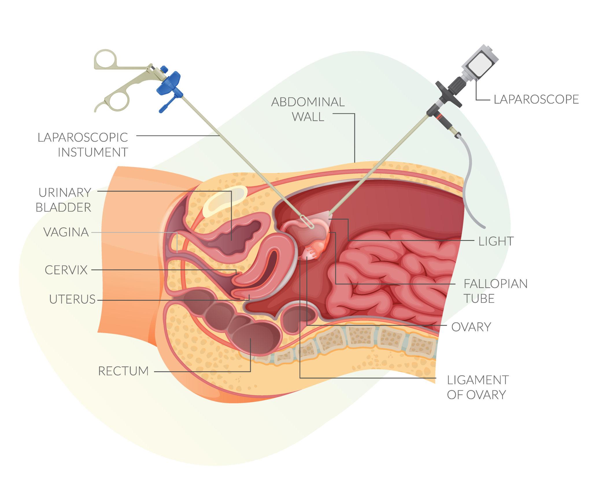 Best Gynec Laparoscopic Surgeon Near Pune – Advanced Minimally Invasive Treatment
